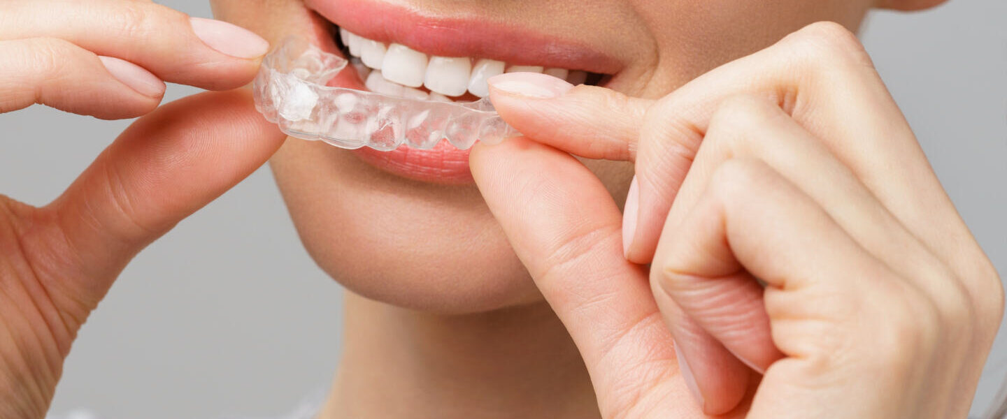 Your Teeth Were Always Going to Move: The Retainer Question Nobody Prepares You For